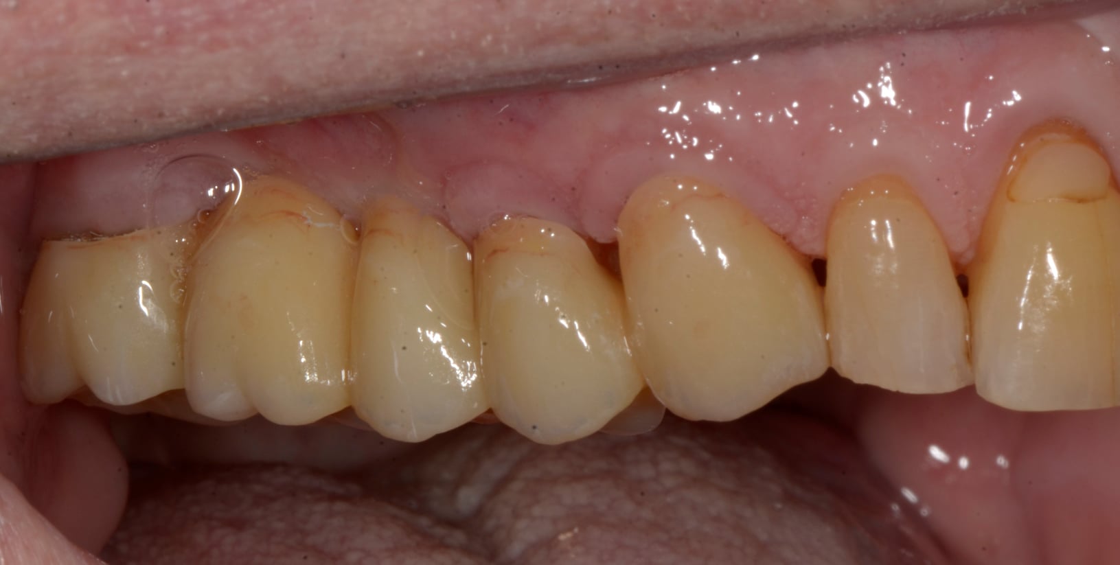Excellent cosmetic dentistry and lab work isn’t always perfectly shaped white teeth for crowns and bridges, but restorations that blend into the rest of the dentition.