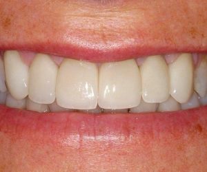 before2Emax-all-porcelain-crowns